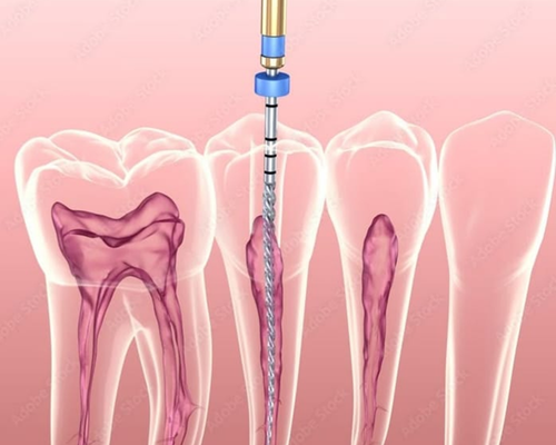 Endodoncia