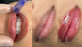 faciales-hidra-lips-standard.png