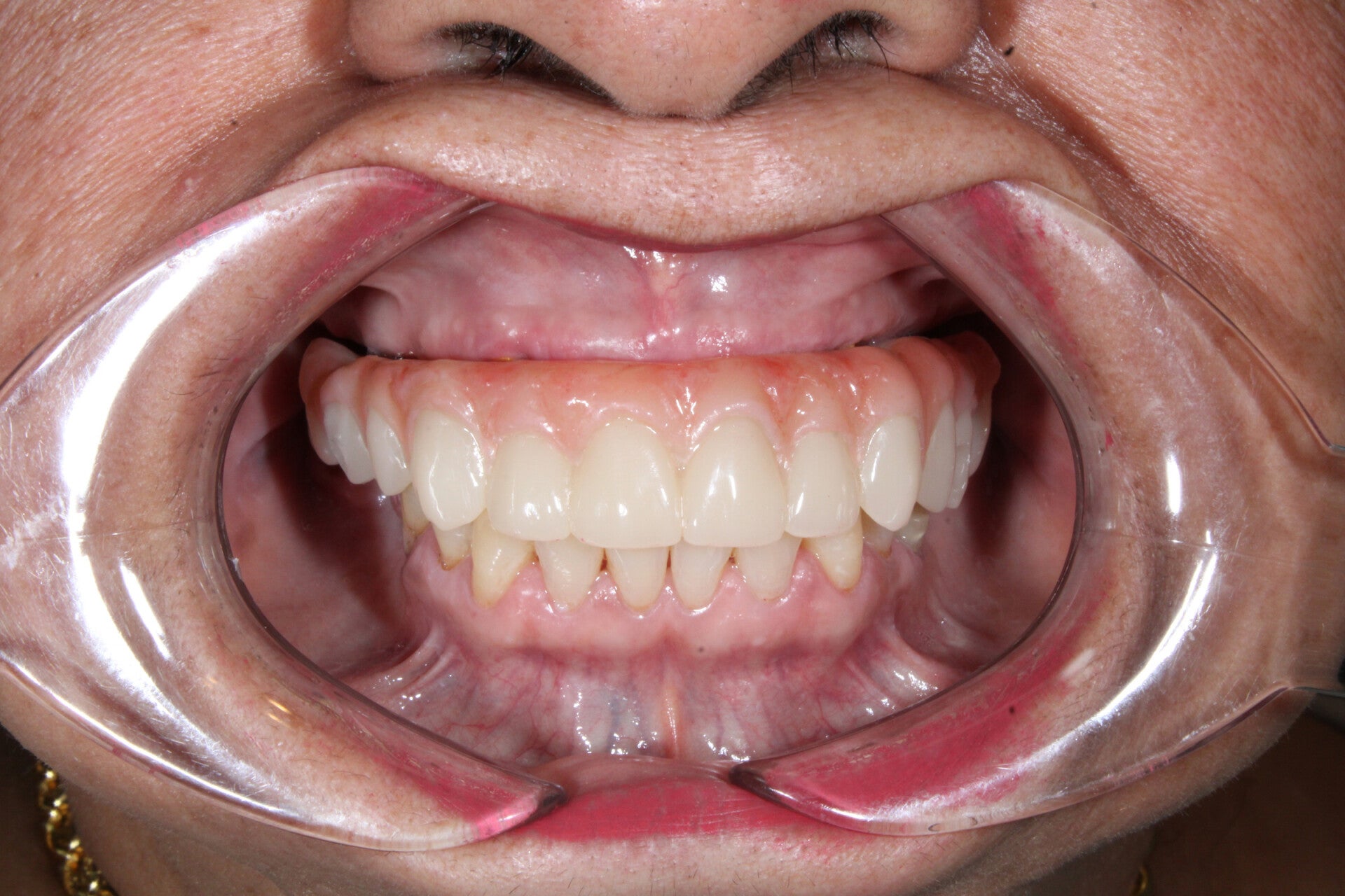 Implantología Dental