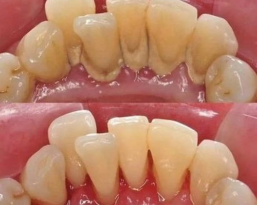 Limpieza Dental