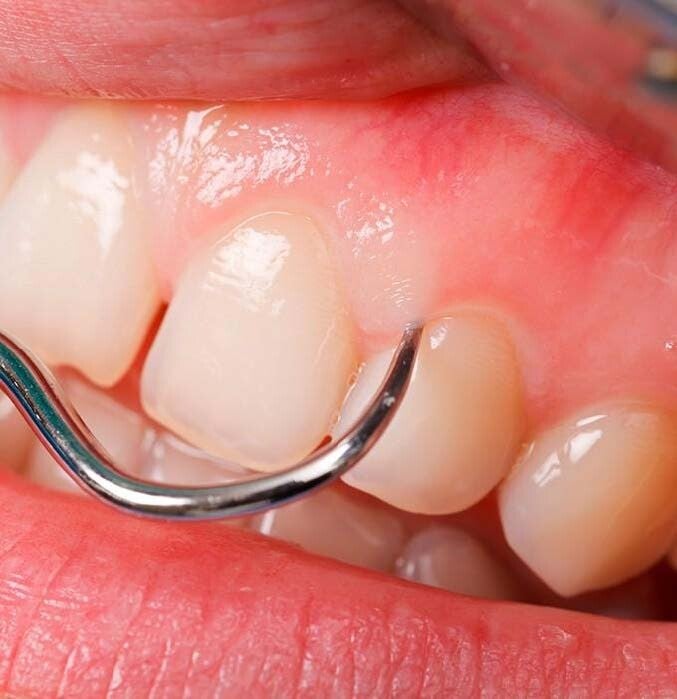 Periodoncia y Cuidado de Encías