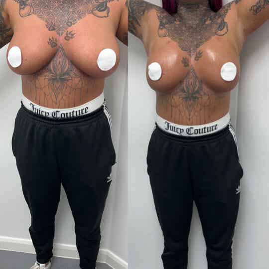 Liquid Breast Filler