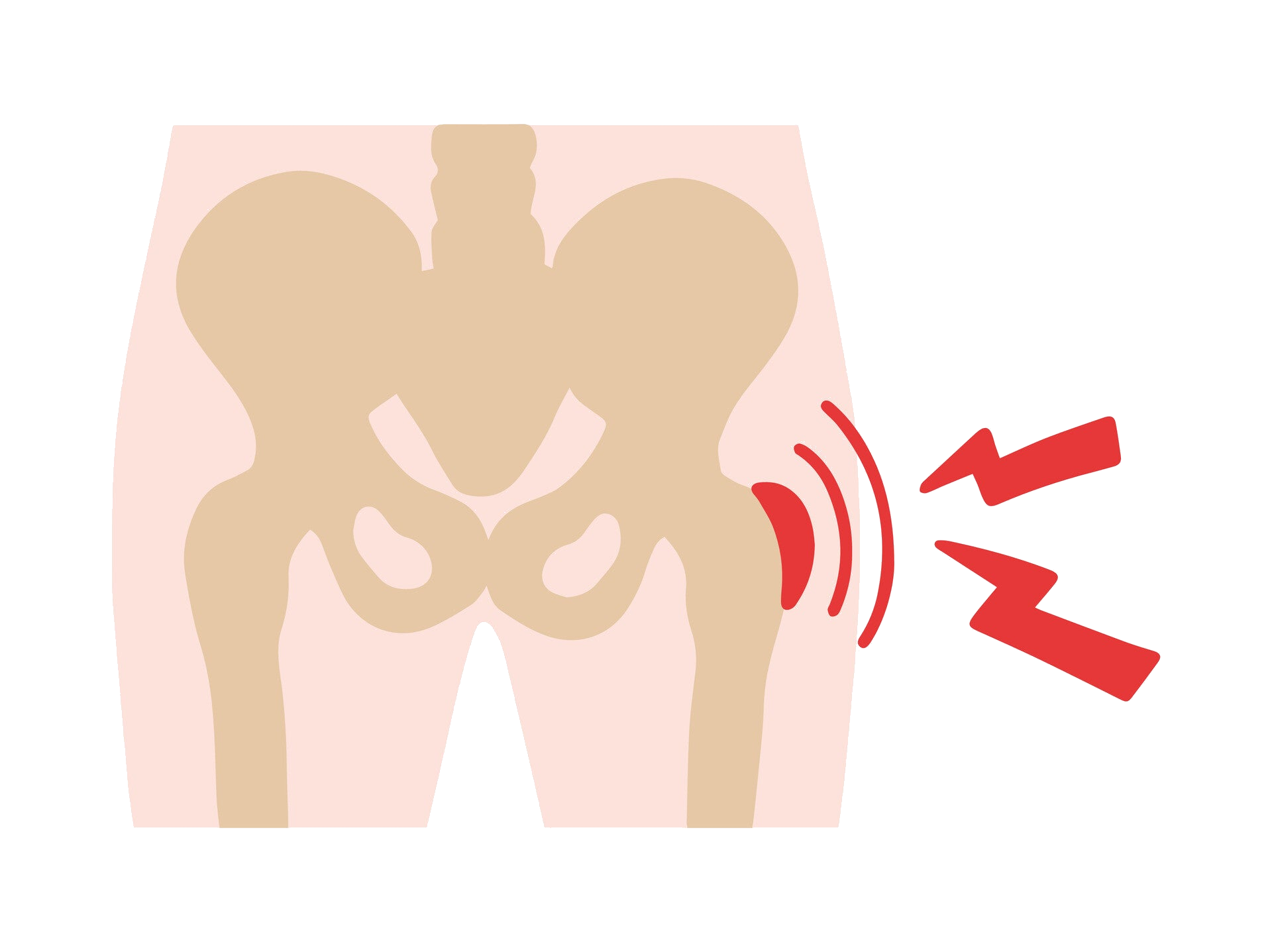 Heupartrose