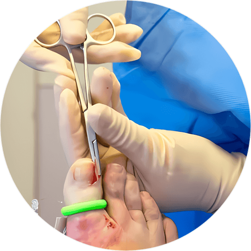 Nail surgery image from The Ledbury Foot and Ankle Clinic's existing services page