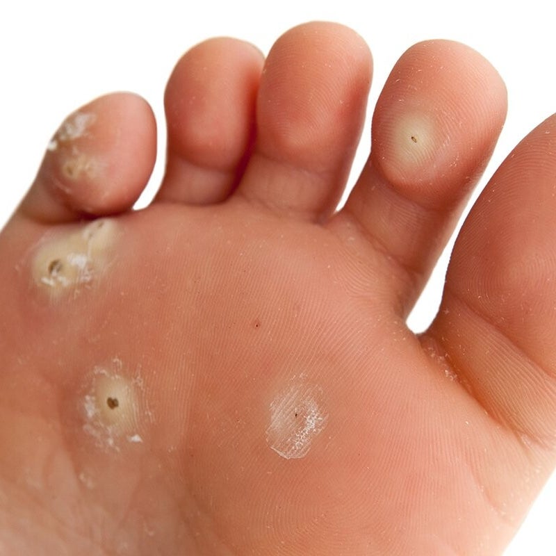 Verruca & Wart Treatments — image from the clinic website