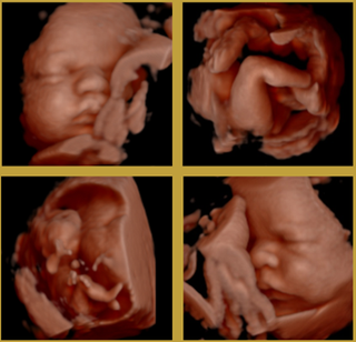 Geslachtsbepaling Echo Voor Aanstaande Ouders