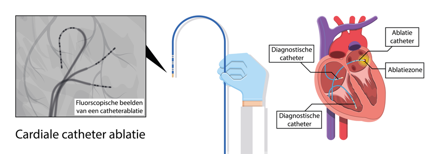 Welke Vormen Van Katheterisatie Hebben De Voorkeur