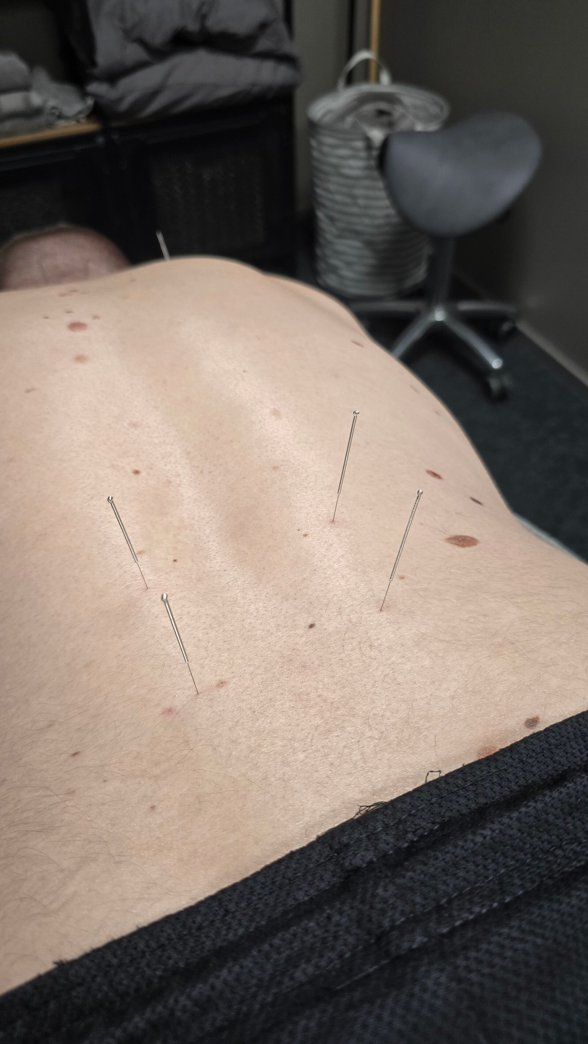 Alasel̈́än dry needling hoito
