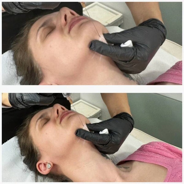 Aqualyx Fat DIssolving Treatment