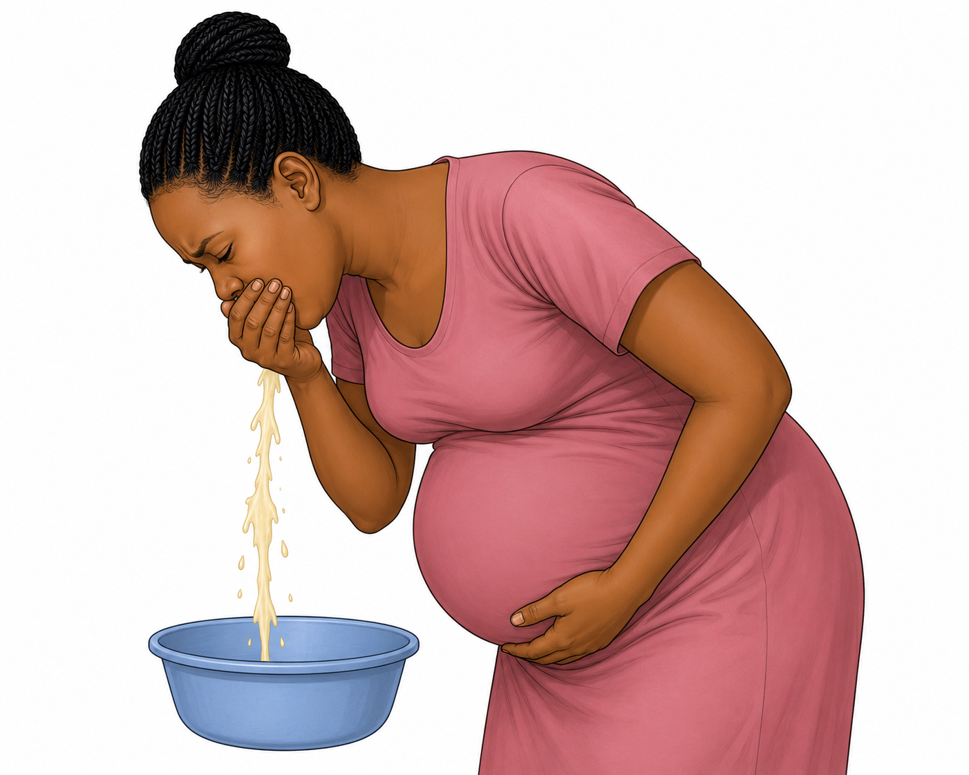 Mchoro wa kielimu unaoonyesha mwanamke mjamzito akitapika kwenye beseni akiwa ameshikilia tumbo lake.