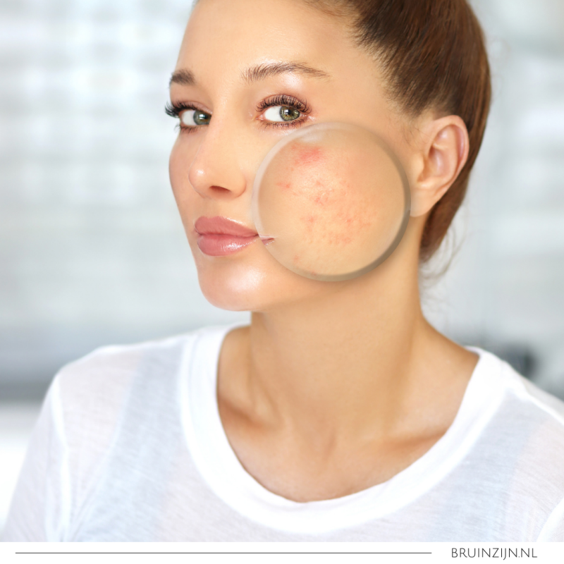 Oplossing voor acne, littekens en spataderen