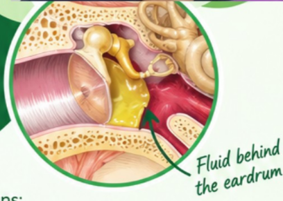 Eastachian tube dysfunction
