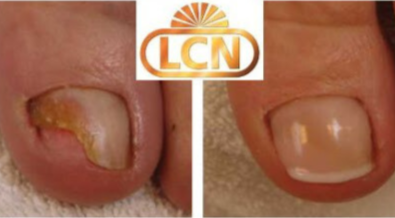 nagelreparatie LCN