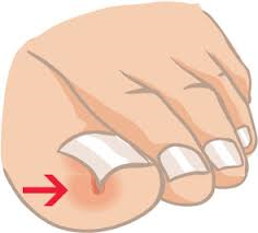 blog ingegroeide teennagel door reconnective healing bilthoven