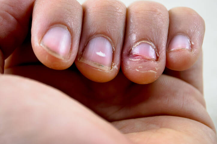 Blog over nagelbijten door Reconnective Healing Bilthoven