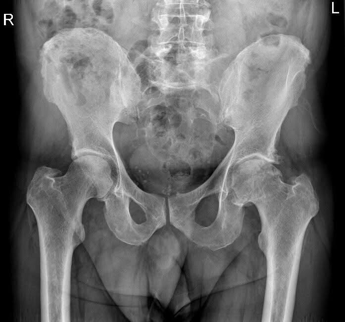 radiografia del bacino che mostra grave artosi di anca sinistra