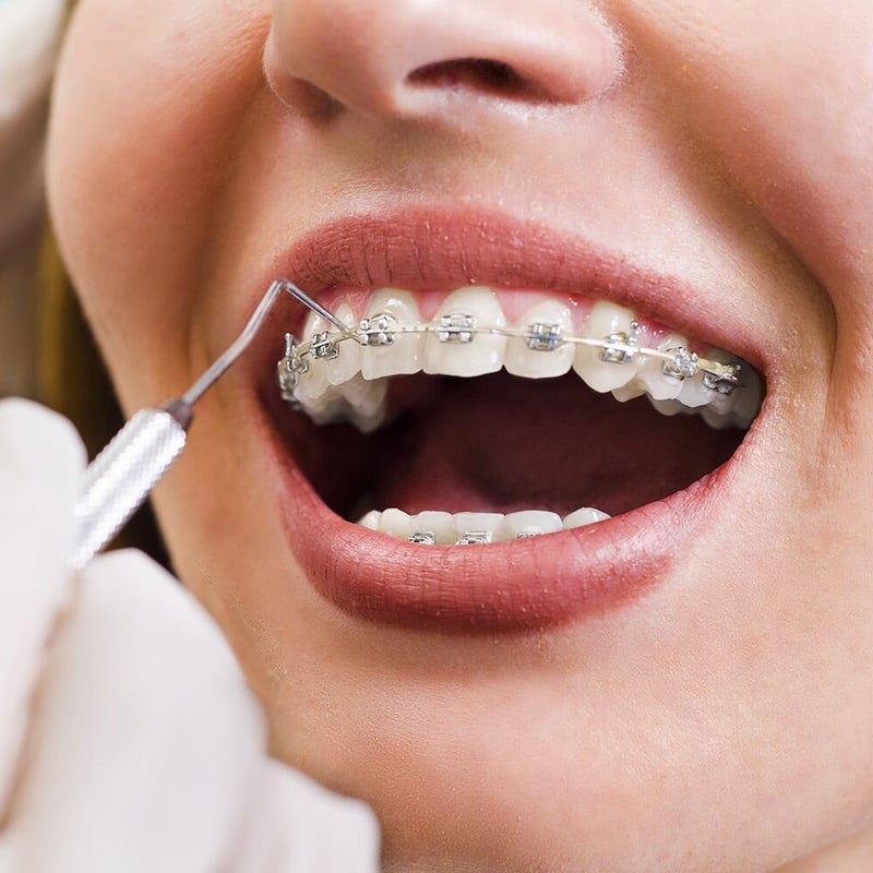 Imagen de paciente en tratamiento ortodóntico con brackets, atendido por ortodoncista.