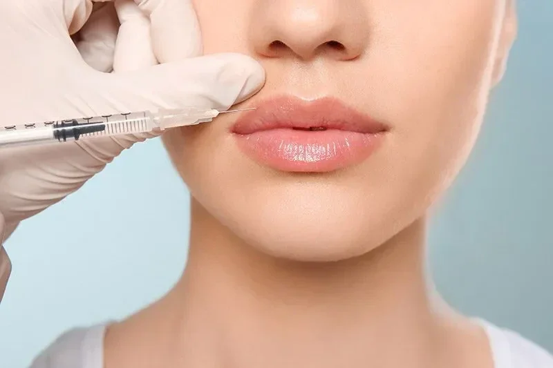 Lip Fillers in North London