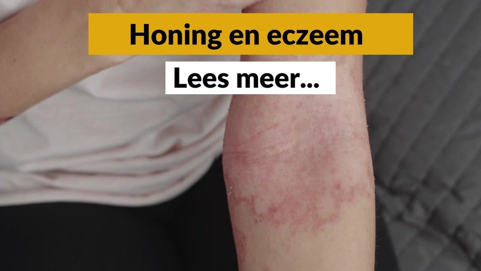 Honing tegen eczeem