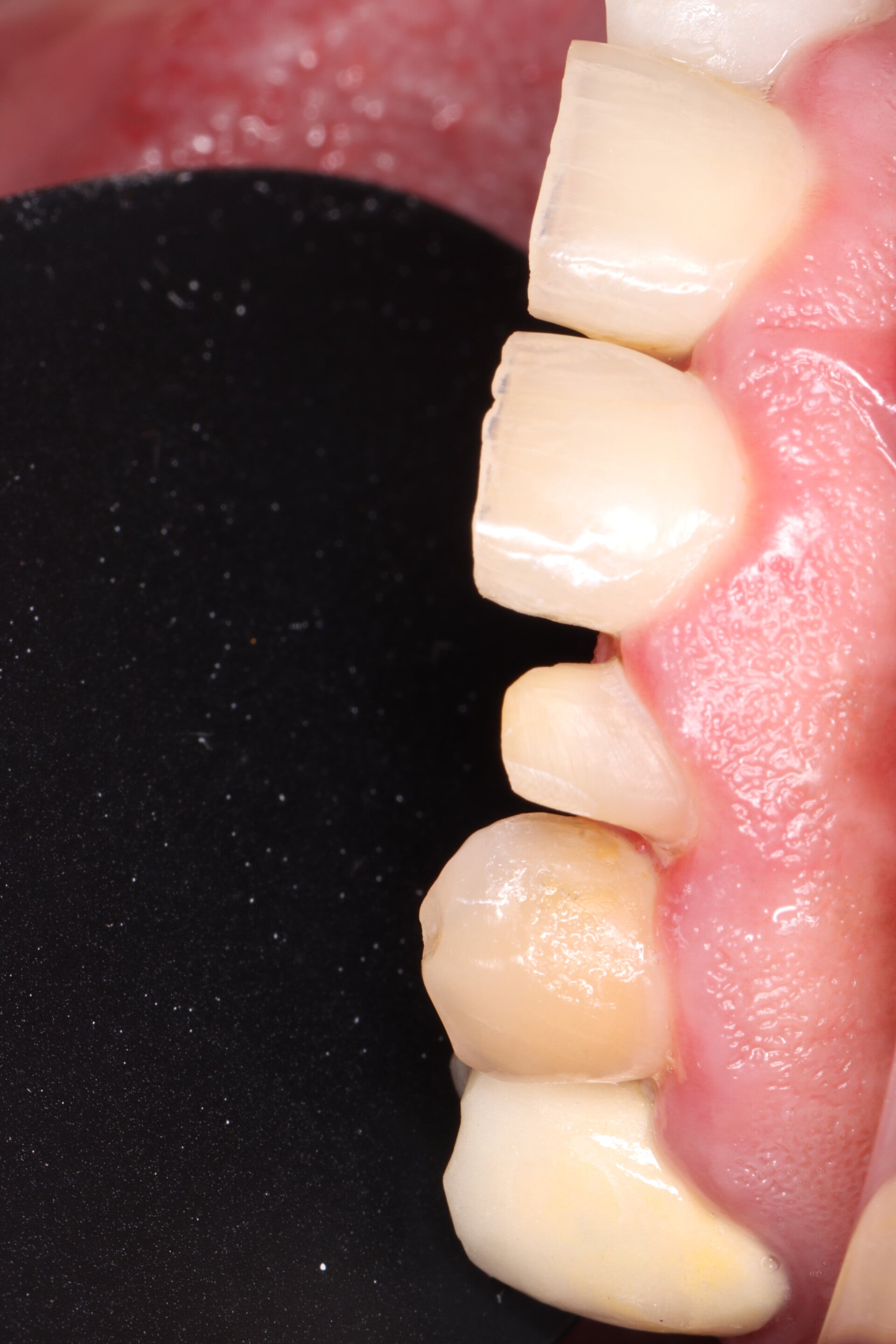 Preparación dental para recibir una corona