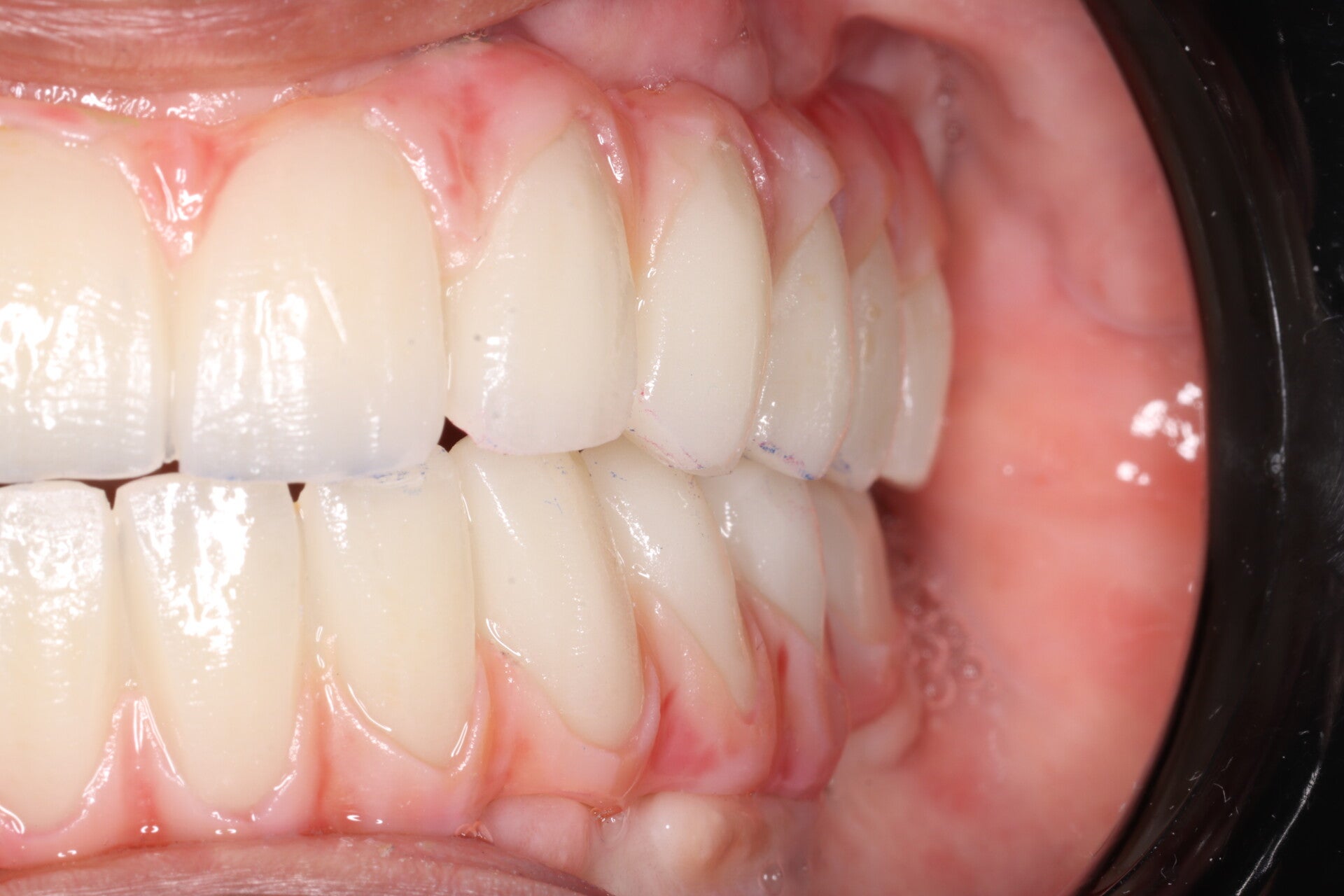 Protesis sobre implantes colocada en boca