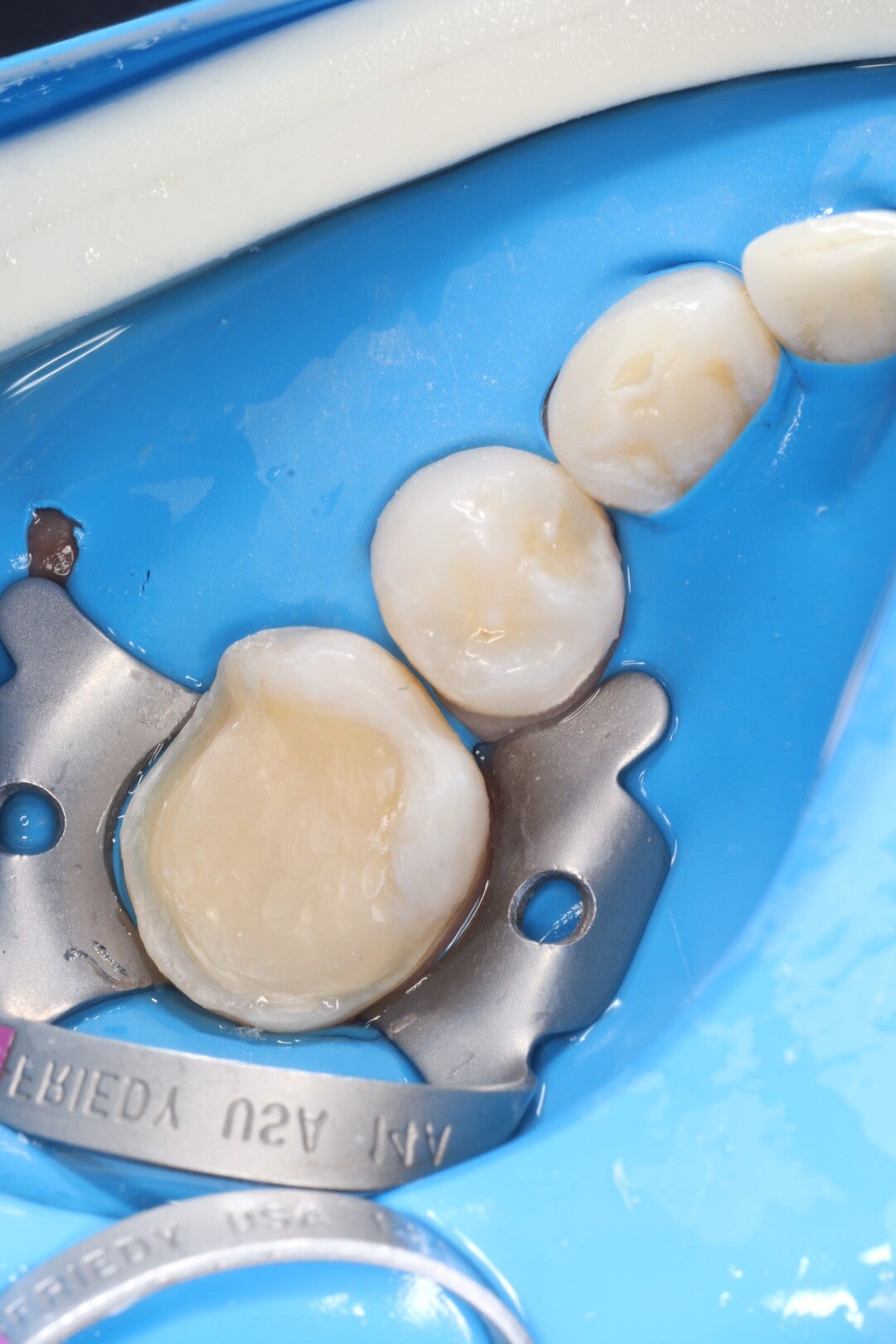 Preparación dental para recibir incrustacion
