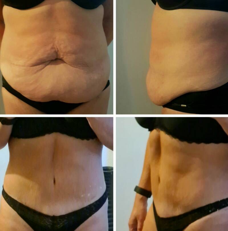 Voor en na foto buikwandcorrecte door Wiebren van den Berg Velthuis Kliniek Velp