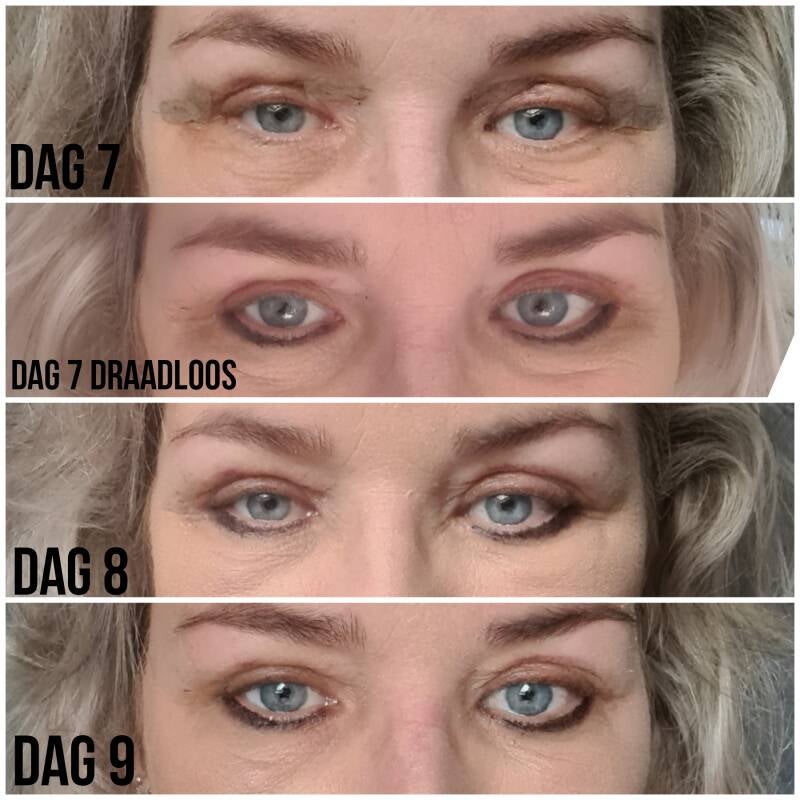 ooglidcorrecite velthuis kliniek Wiebren van den Berg plastische chirurg