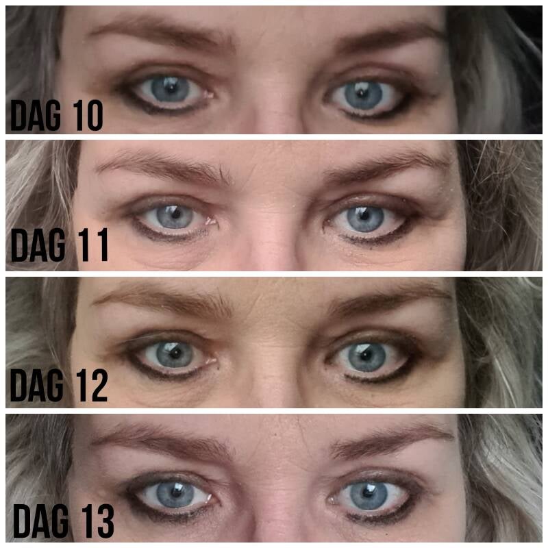 ooglidcorrecite velthuis kliniek Wiebren van den Berg plastische chirurg