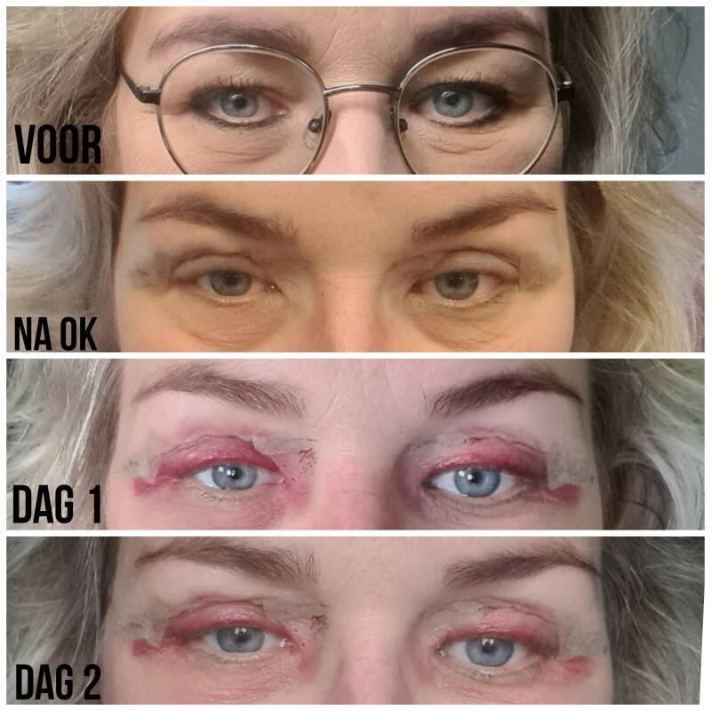 ooglidcorrecite velthuis kliniek Wiebren van den Berg plastische chirurg