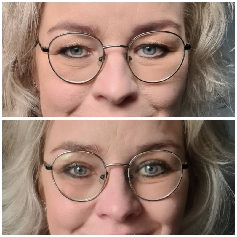 voor en na foto ooglidcorrecite velthuis kliniek Wiebren van den Berg plastische chirurg