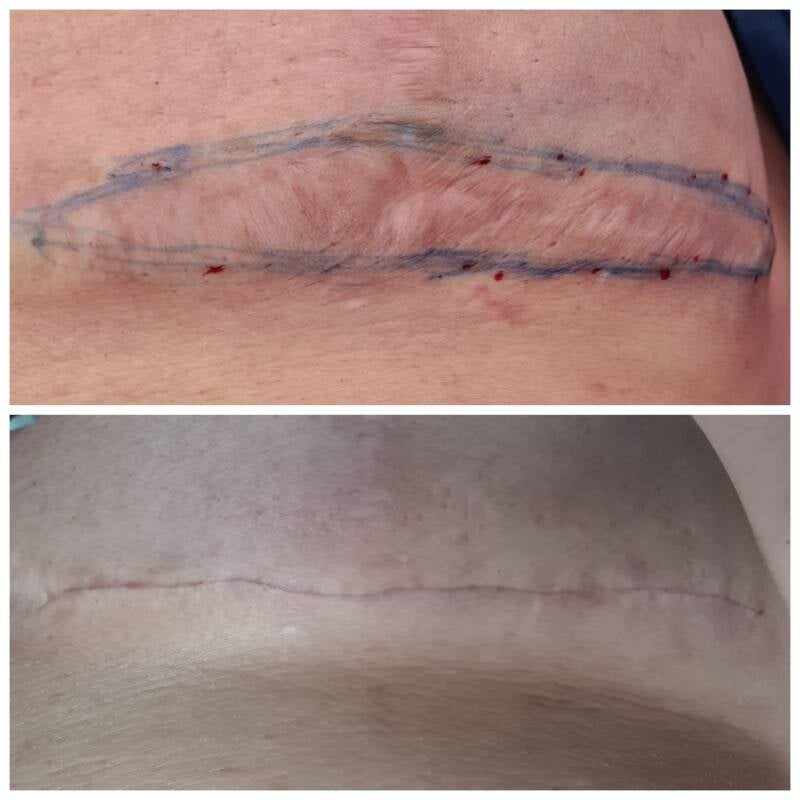 Voor en na foto Borstlift ankermethode velthuis kliniek Wiebren van den Berg plastische chirurgie