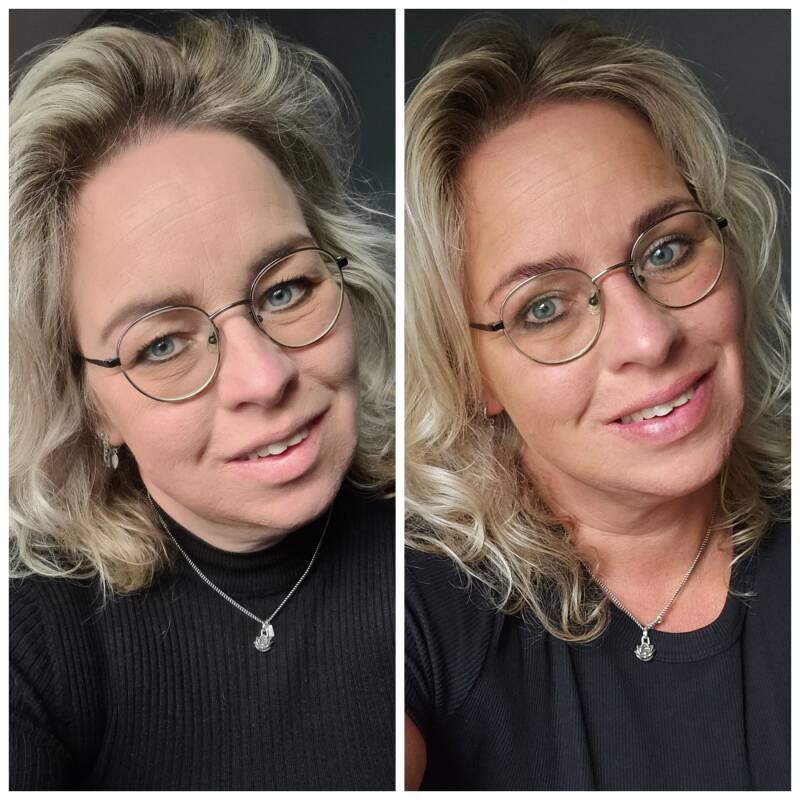 resultaat voor en na foto's ooglidcorrectie Wiebren van den Berg Velthuis Kliniek Karin Abbink