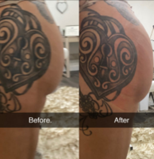Cavitation