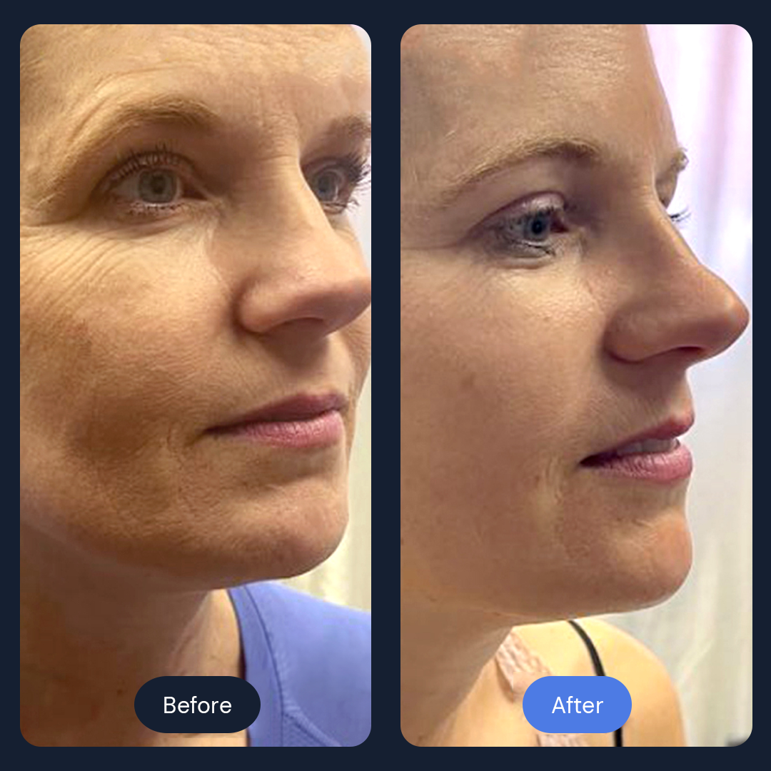 cryo-slimming-level-2-qhht-reiki-healing-ana-s-light-healing-center-mi