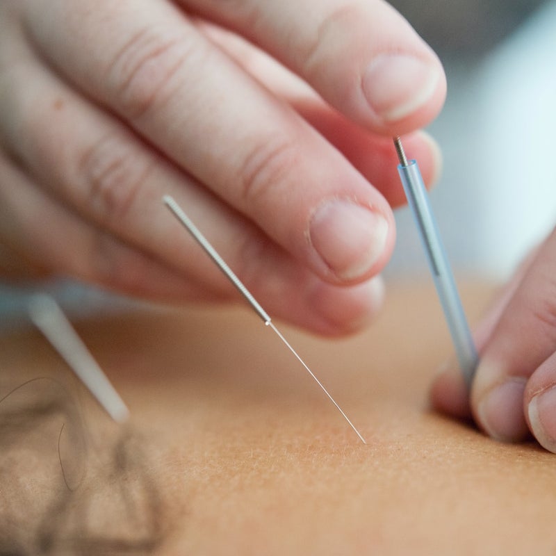 Acupunctuurnaaldjes